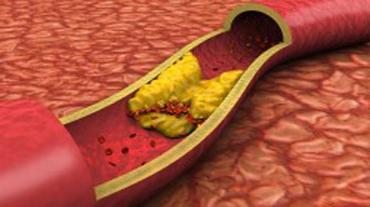 Атеросклероза на съдовете - симптоми, причини и лечение