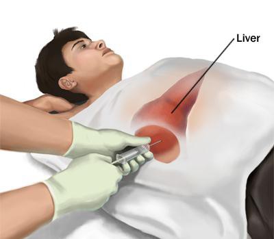 как да направите чернодробна биопсия