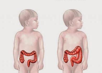 Болестта на Hirschsprung при симптомите на детето