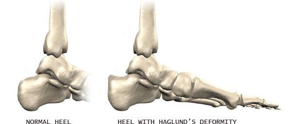 haglund деформация как да се лекува