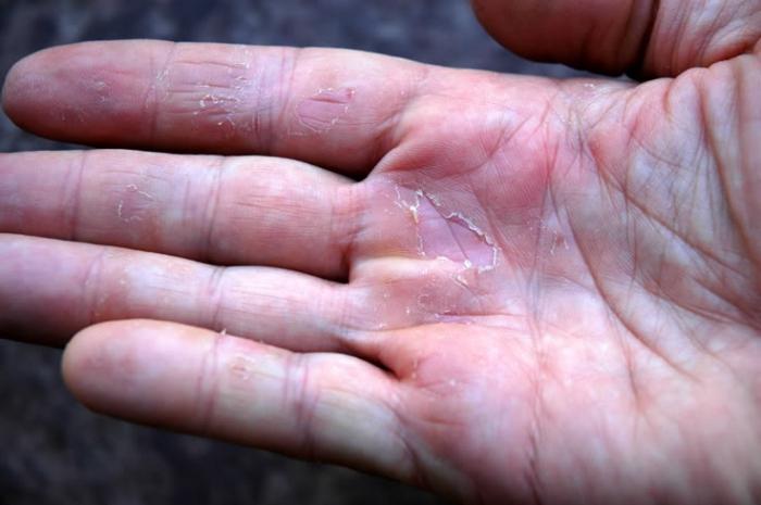 Хапче върху ръцете: причини, симптоми и лечение