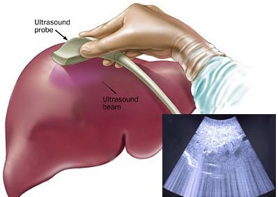 Ултразвук на черния дроб: подготовка за процедурата, индикации