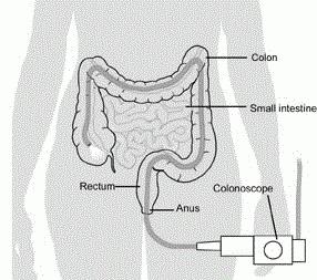 Виртуална колоноскопия на червата: прегледи и описание на процедурата