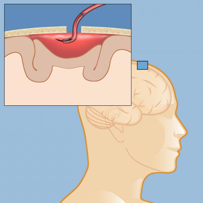 отстраняване на хематома вътречерепно